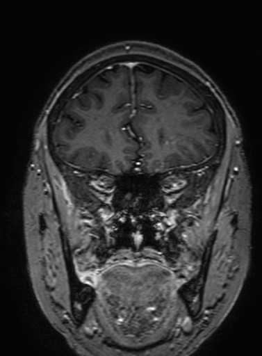 Cavernous hemangioma of the cerebellar falx (Radiopaedia 73025-83724 Coronal T1 C+ 106).jpg