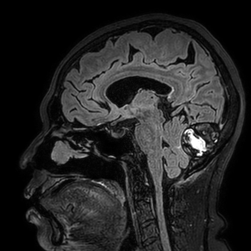Cavernous hemangioma of the cerebellar falx (Radiopaedia 73025-83724 Sagittal FLAIR 98).jpg