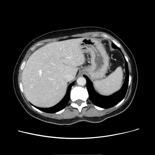Cecal adenocarcinoma (Radiopaedia 75909-87331 A 22).jpg