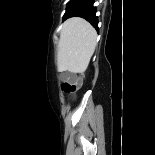 Cecal adenocarcinoma (Radiopaedia 75909-87331 C 16).jpg