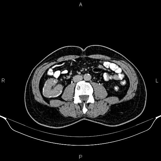 Cecal adenocarcinoma (Radiopaedia 85324-100916 Axial C+ delayed 54).jpg