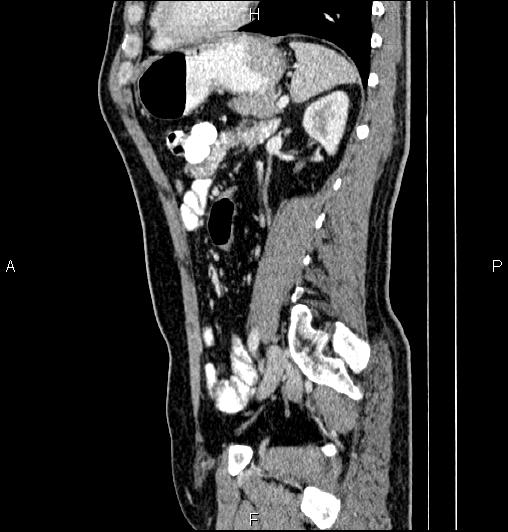 Cecal adenocarcinoma (Radiopaedia 85324-100916 E 61).jpg