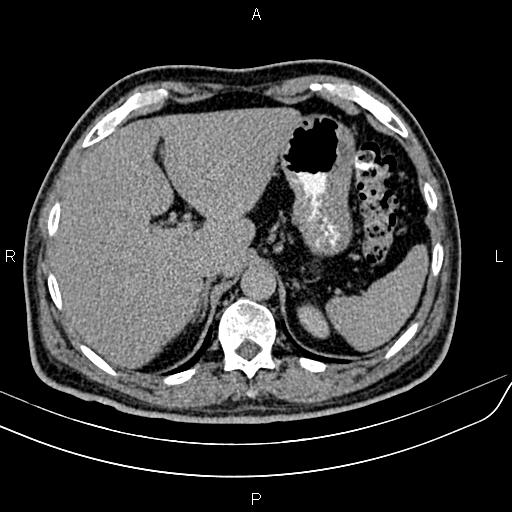 File:Cecal cancer with appendiceal mucocele (Radiopaedia 91080-108651 Axial C+ delayed 4).jpg