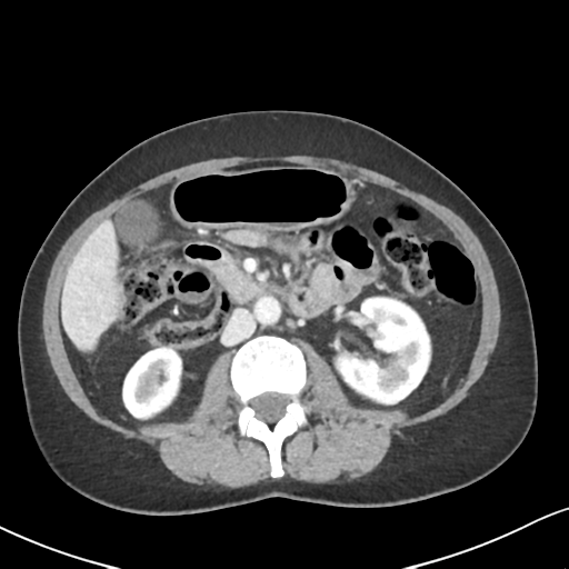 Cecal internal hernia through the foramen of Winslow (Radiopaedia 44820-48651 B 34).png