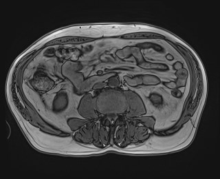 Cecal mass causing appendicitis (Radiopaedia 59207-66532 D 75).jpg