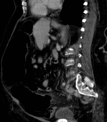 File:Celiac artery compression syndrome (Radiopaedia 24287-24570 A 7).jpg