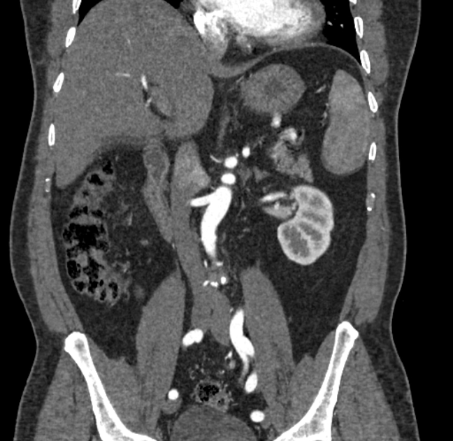 Celiac artery dissection (Radiopaedia 52194-58080 C 61).jpg