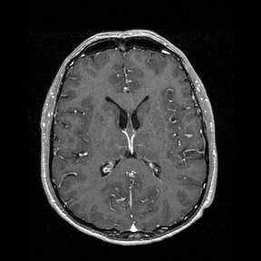 Central-variant posterior reversible encephalopathy syndrome (PRES) (Radiopaedia 43880-47358 Axial T1 C+ 92).jpg