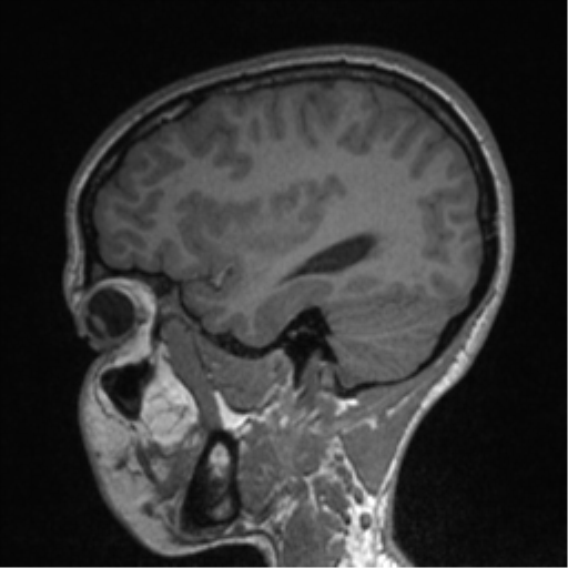 Central neurocytoma (Radiopaedia 37664-39557 Sagittal T1 71).png