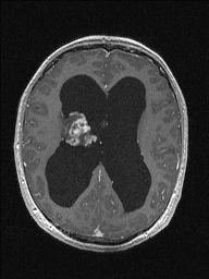 Central neurocytoma (Radiopaedia 56690-63469 Axial T1 C+ 98).jpg