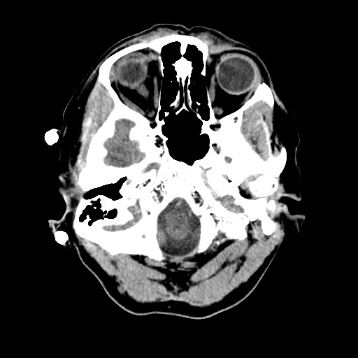 Central neurocytoma (Radiopaedia 68725-78432 Axial non-contrast 6).jpg