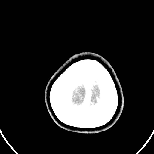 Central neurocytoma (Radiopaedia 84497-99871 B 49).jpg