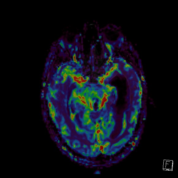 Central neurocytoma (Radiopaedia 84497-99872 Axial Perfusion 196).jpg