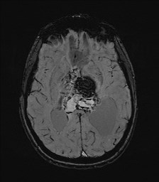 Central neurocytoma (Radiopaedia 84497-99872 Axial SWI 37).jpg