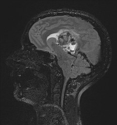 Central neurocytoma (Radiopaedia 84497-99872 Sagittal Flair + Gd 84).jpg