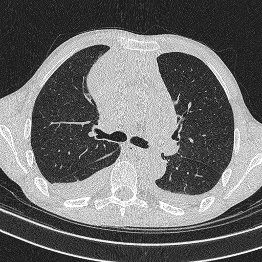 Central venous catheter tip extravasation (Radiopaedia 82828-97113 Axial lung window 37).jpg
