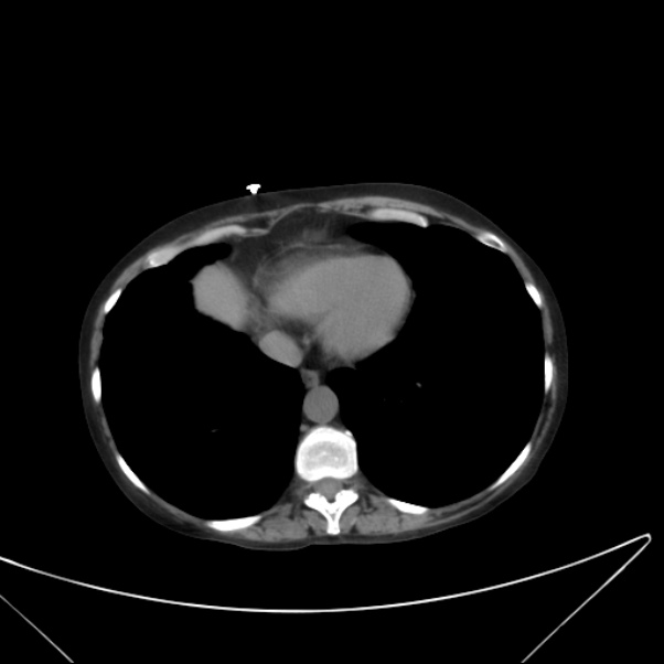 Centrilobular pulmonary emphysema (Radiopaedia 24495-24789 Axial non-contrast 37).jpg