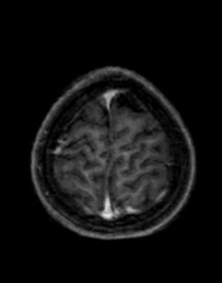 Cerebellar abscess (Radiopaedia 73727-84563 Axial T1 C+ fat sat 96).jpg