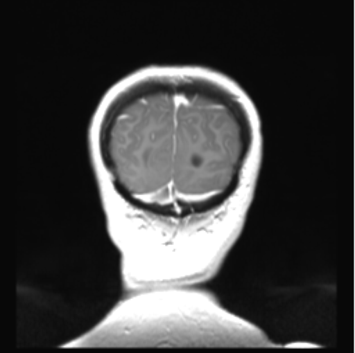 Cerebellar ependymoma complicated by post-operative subdural hematoma (Radiopaedia 83322-97736 Coronal T1 C+ 53).png