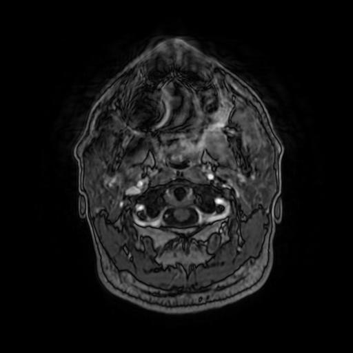 Cerebellar hemangioblastoma (Radiopaedia 88055-104622 Axial T1 C+ 17).jpg