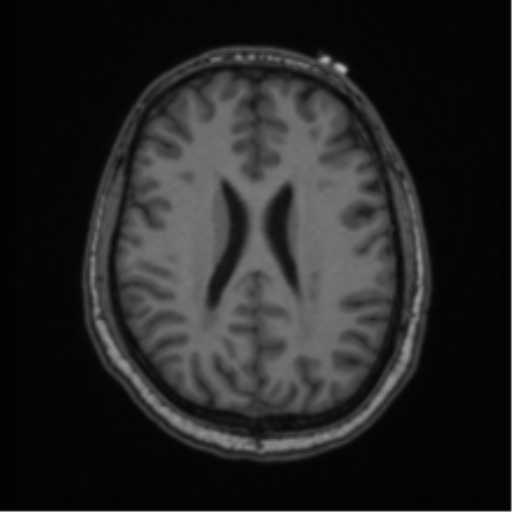 Cerebellar hemangioblastomas and pituitary adenoma (Radiopaedia 85490-101176 Axial T1 47).png