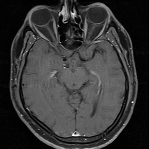 File:Cerebellar hemangioblastomas and pituitary adenoma (Radiopaedia 85490-101176 Axial T1 C+ fat sat 18).png