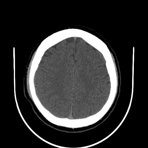 File:Cerebellar infarction (Radiopaedia 16625-16327 Axial non-contrast 28).jpg