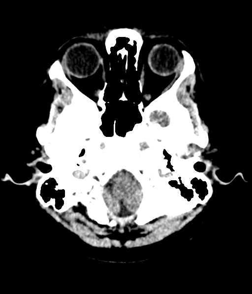 Cerebellar metastases - colorectal adenocarcinoma (Radiopaedia 40947-43652 Axial non-contrast 8).png