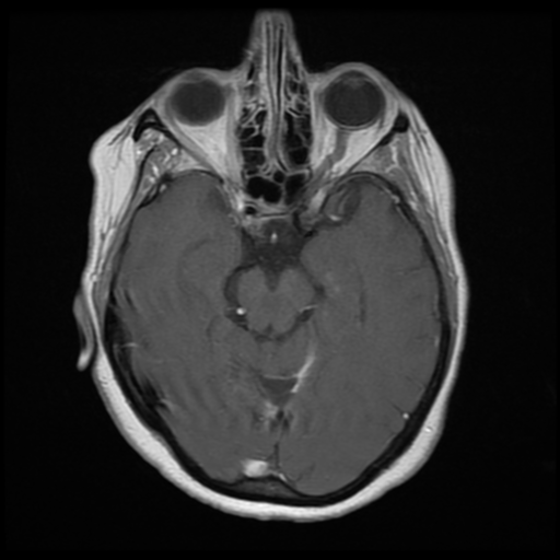 File:Cerebellar metastasis (cystic appearance) (Radiopaedia 41395-44268 Axial T1 C+ 9).png