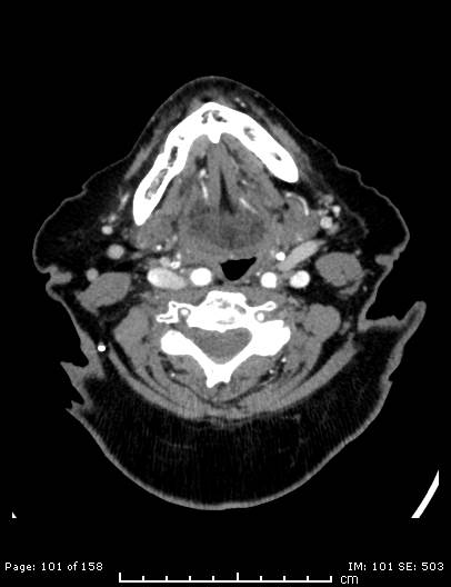 Cerebellar strokes due to intracranial giant cell arteritis (Radiopaedia 68799-78510 CT angiogram 101).jpg