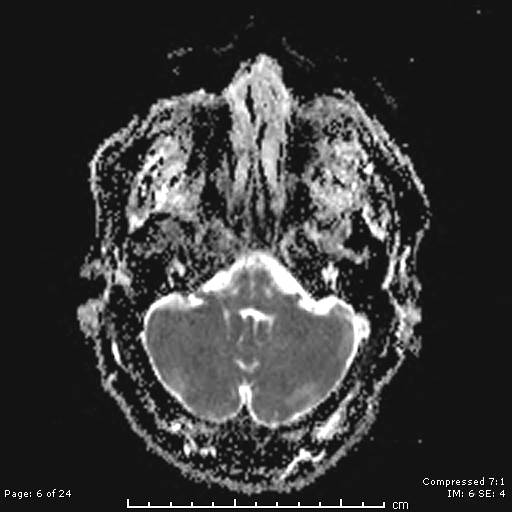 File:Cerebellar strokes due to intracranial giant cell arteritis (Radiopaedia 68799-81713 Axial ADC 6).jpg