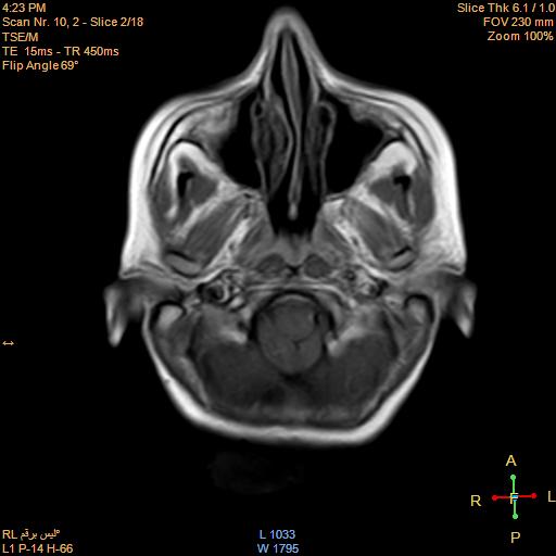 File:Cerebellopontine angle meningioma (Radiopaedia 22488-22525 Axial T1 C+ 1).jpg