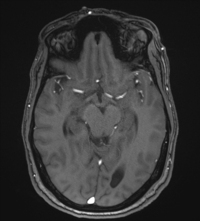 Cerebellopontine angle meningioma (Radiopaedia 72983-83680 Axial MRA 53).jpg