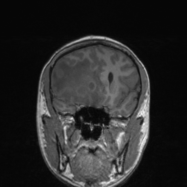 Cerebral abscess (Radiopaedia 24212-24478 Coronal T1 80).jpg