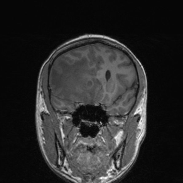 Cerebral abscess (Radiopaedia 24212-24478 Coronal T1 82).jpg