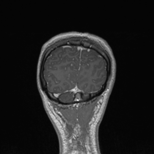Cerebral abscess (Radiopaedia 24212-24478 Coronal T1 C+ 177).jpg