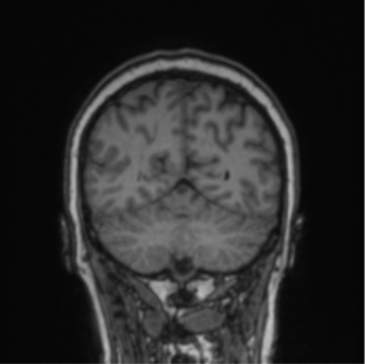 Cerebral abscess from pulmonary arteriovenous malformation (Radiopaedia 86275-102291 Coronal T1 26).png