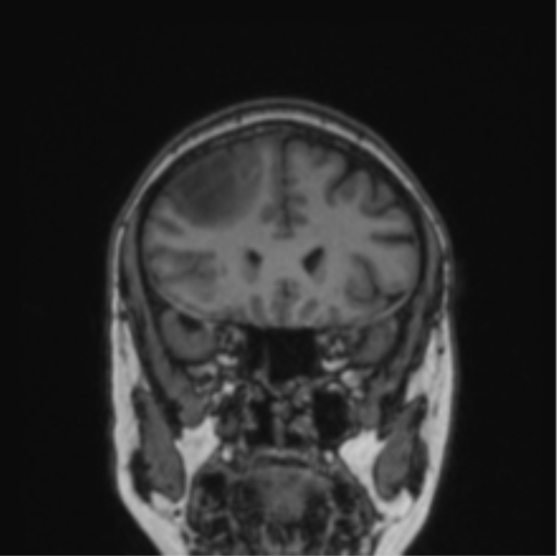Cerebral abscess from pulmonary arteriovenous malformation (Radiopaedia 86275-102291 Coronal T1 64).png