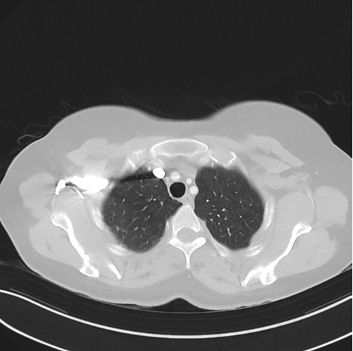 Cerebral abscess from pulmonary arteriovenous malformation (Radiopaedia 86275-102292 Axial lung window 14).png