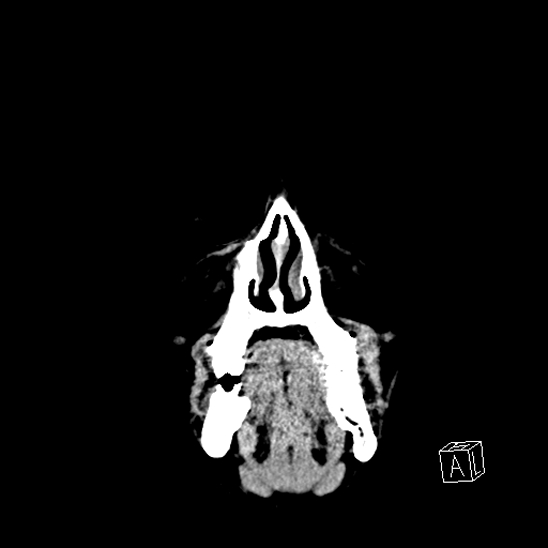 File:Cerebral abscess with ventriculitis (Radiopaedia 78965-91876 B 1).jpg