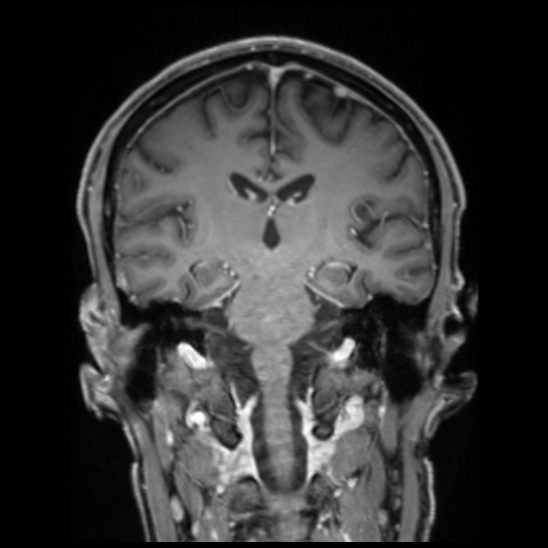 Cerebral abscess with ventriculitis (Radiopaedia 78965-91878 Coronal T1 C+ 36).jpg