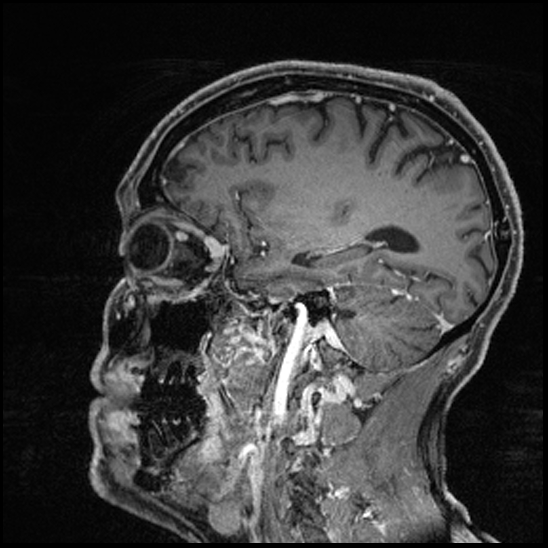 Cerebral abscess with ventriculitis (Radiopaedia 78965-91878 Sagittal T1 C+ 125).jpg