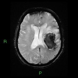 File:Cerebral amyloid angiopathy-associated lobar intracerebral hemorrhage (Radiopaedia 58376-65512 Axial Gradient Echo 11).jpg