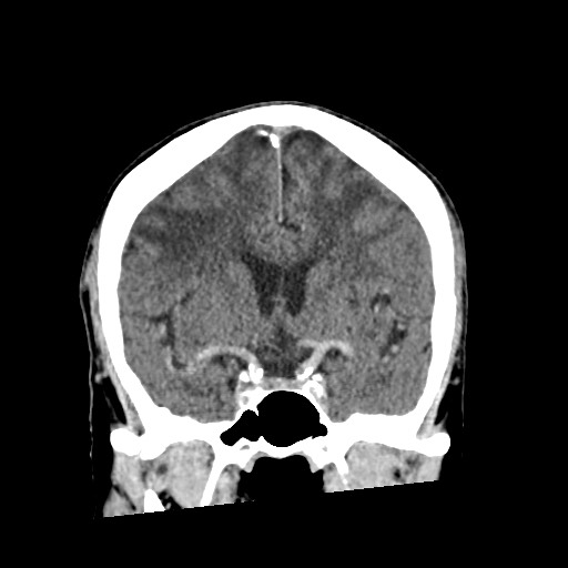 File:Cerebral amyloid angiopathy-related inflammation (Radiopaedia 74836-85848 Coronal non-contrast 31).jpg