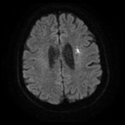 Cerebral amyloid angiopathy (Radiopaedia 28698-28978 Axial DWI 20).jpg