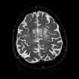 Cerebral amyloid angiopathy (Radiopaedia 28698-28978 Axial DWI 51).jpg