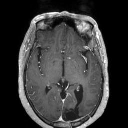 Cerebral amyloid angiopathy (Radiopaedia 29129-29518 Axial T1 C+ 72).jpg