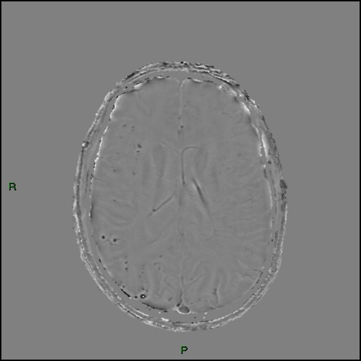 Cerebral amyloid angiopathy (Radiopaedia 77506-89664 H 62).jpg