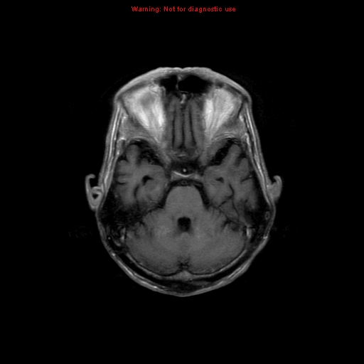File:Cerebral and orbital tuberculomas (Radiopaedia 13308-13311 Axial T1 C+ 7).jpg