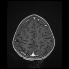 Cerebral and spinal tuberculosis (Radiopaedia 90489-107837 Axial T1 C+ 157).jpg